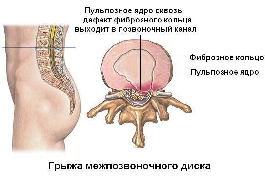 Exercícios para a coluna em bola de acordo com Bubnovsky, com osteocondrose e hérnia da coluna lombar