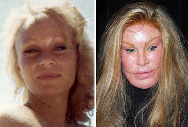 Opfer der plastischen Chirurgie: Russische Prominente und Stars auf der ganzen Welt, Männer und Frauen. Vor und nach Fotos