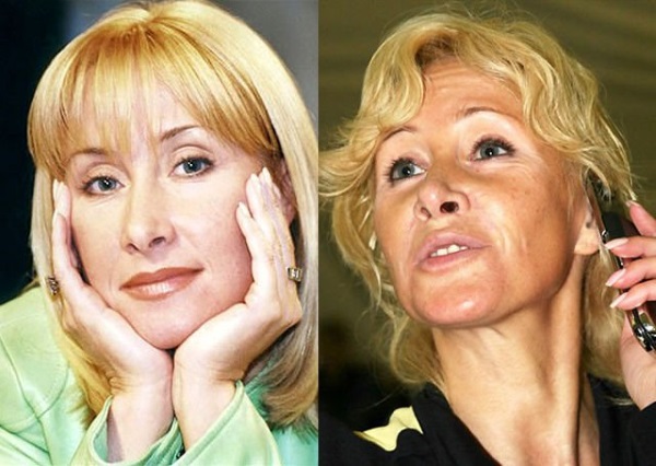 Mangsa pembedahan plastik: selebriti dan bintang Rusia di seluruh dunia, lelaki dan wanita. Foto sebelum dan selepas
