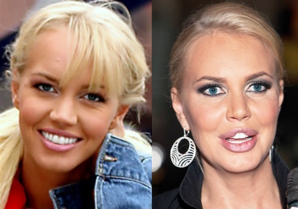 ضحايا عمليات التجميل: مشاهير ونجوم روس حول العالم رجال ونساء. قبل وبعد الصور
