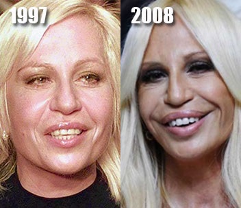 Vítimas de cirurgia plástica: celebridades russas e estrelas de todo o mundo, homens e mulheres. Fotos antes e depois