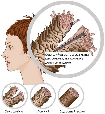 El cabello graso en la raíz y en toda la longitud, seco en las puntas, se cae. Causas y tratamiento: champús, mascarillas, aceites, bálsamos.
