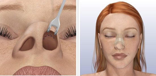 Rhinoplastie du nez, non chirurgicale, fermée, ouverte, reconstructive, injection, rééducation