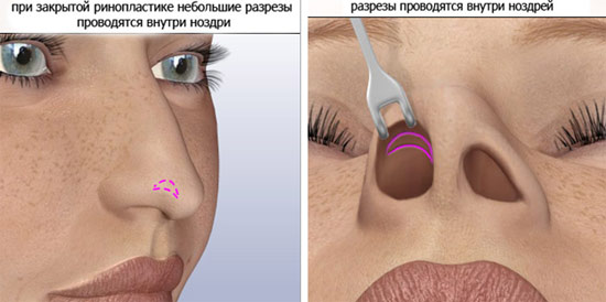 Rhinoplasty hidung, bukan pembedahan, tertutup, terbuka, rekonstruktif, suntikan, pemulihan