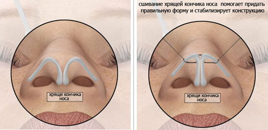Ринопластика носа, нехируршка, затворена, отворена, реконструктивна, ињекција, рехабилитација