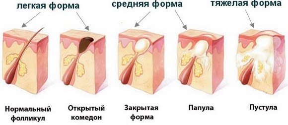 Antibiotics para sa acne sa mukha: tablet, pamahid, cream, gel, injection