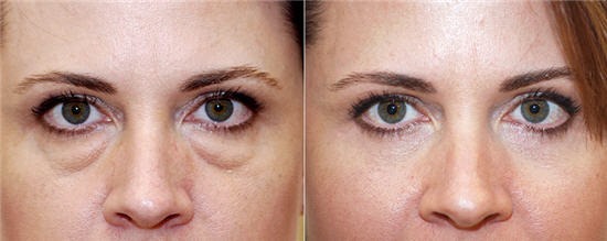 Blepharoplasty. Hình ảnh trước và sau khi phẫu thuật cắt mí mắt dưới, mí trên, phẫu thuật tạo hình mí mắt bằng laser, tròn, tiêm. Hoạt động, phục hồi, đánh giá và giá cả như thế nào