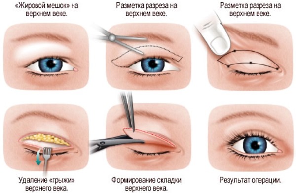 Blefaroplastikk. Bilder før og etter operasjonen av nedre, øvre øyelokk, laser, sirkulær, plastisk kirurgi av øyelokkene. Hvordan er drift, rehabilitering, anmeldelser og priser