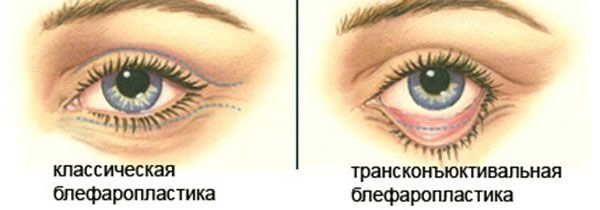 Blepharoplastik. Fotos vor und nach der Operation der unteren, oberen Augenlider, Laser, kreisförmige, injizierende plastische Chirurgie der Augenlider. Wie ist die Operation, Rehabilitation, Bewertungen und Preise