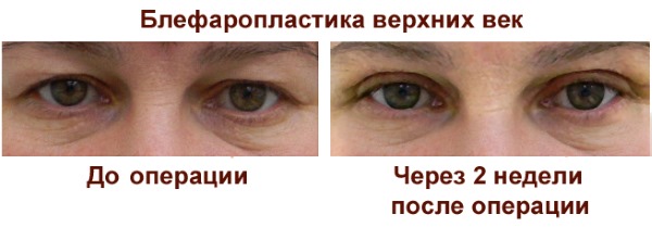Blepharoplasztika. Fotók az alsó, a felső szemhéj, a lézer, a kör alakú, a szemhéj injekciós műanyagának műtéte előtt és után. Milyen a művelet, a rehabilitáció, a felülvizsgálatok és az árak