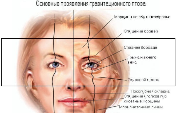 Blepharoplasty. Hình ảnh trước và sau khi phẫu thuật cắt mí mắt dưới, trên, laser, ép tròn, tiêm nhựa mí mắt. Hoạt động, phục hồi, đánh giá và giá cả như thế nào