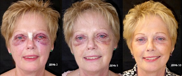Blefaroplàstia. Fotos abans i després de l'operació de les parpelles inferiors, superiors, làser, circular, cirurgia plàstica per injecció de les parpelles. Com és l'operació, rehabilitació, revisions i preus