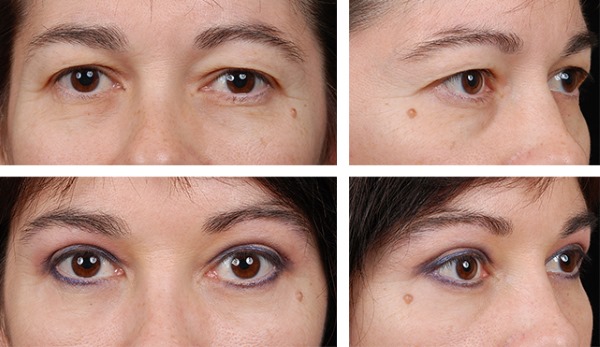 Ooglidcorrectie. Foto's voor en na de operatie van de onderste, bovenste oogleden, laser, circulaire, injectie plastische chirurgie van de oogleden. Hoe is de operatie, revalidatie, beoordelingen en prijzen