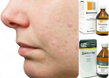 Prater voor acne. Recept voor dermatologen met levomycetine en salicylzuur. Hoe te bereiden en te gebruiken