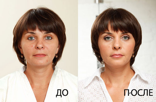 Lifting facial endoscòpic: front i celles, coll, pòmuls, part temporal. Com es fa, fotos, rehabilitació i conseqüències