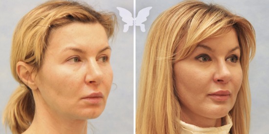 Lifting facial endoscópico: frente y cejas, cuello, pómulos, parte temporal. Cómo se hace, fotos, rehabilitación y consecuencias