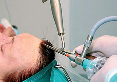 Endoskopski lifting lica: čelo i obrve, vrat, jagodične kosti, sljepoočni dio. Kako se to radi, fotografije, rehabilitacija i posljedice