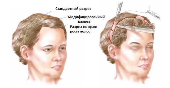 Endoskopisches Facelifting: Stirn und Augenbrauen, Hals, Wangenknochen, Schläfenbereich. Wie geht das, Fotos, Rehabilitation und Konsequenzen