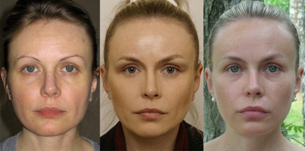 Lifting facial endoscòpic: front i celles, coll, pòmuls, part temporal. Com es fa, fotos, rehabilitació i conseqüències