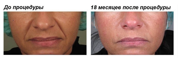 Fillers based on hyaluronic acid. Names, types, action, application effects, prices and reviews