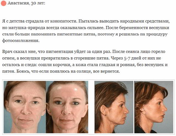 Fotorejoveniment de la cara: què és, avantatges i desavantatges, abans i després de les fotos, indicacions i contraindicacions