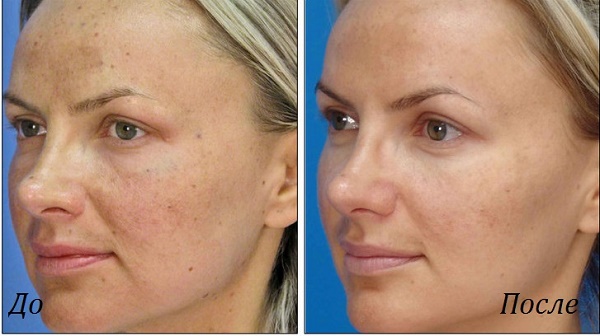 Photorejuvenation of the face - what is it, pros and cons, before and after photos, indications and contraindications