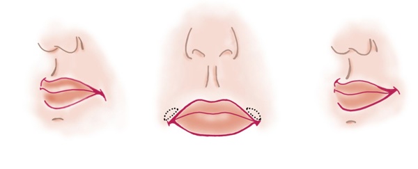 Cheiloplasti bibir: sebelum dan selepas foto, jenis, petunjuk dan kontraindikasi. Bagaimana operasi dan pemulihan berjalan?