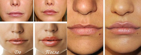 Chéiloplastie des lèvres: photos avant et après, types, indications et contre-indications. Comment se déroulent l'opération et la réhabilitation?