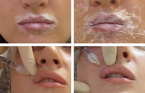 Cheiloplasti bibir: sebelum dan selepas foto, jenis, petunjuk dan kontraindikasi. Bagaimana operasi dan pemulihan berjalan?