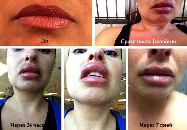 Queiloplastia dos lábios: fotos antes e depois, tipos, indicações e contra-indicações. Como está indo a operação e a reabilitação?