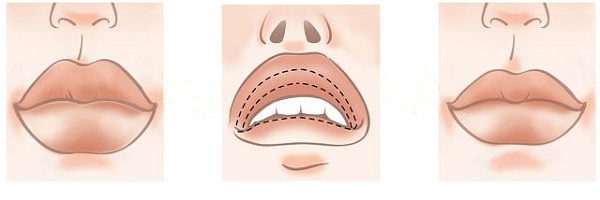 Queiloplastia de labios: fotos antes y después, tipos, indicaciones y contraindicaciones. ¿Cómo va la operación y rehabilitación?