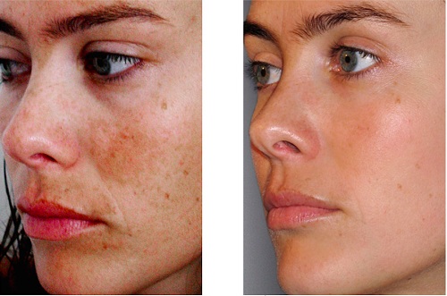 Peeling químico facial no salão e em casa. Comentários, fotos de antes e depois, prós e contras