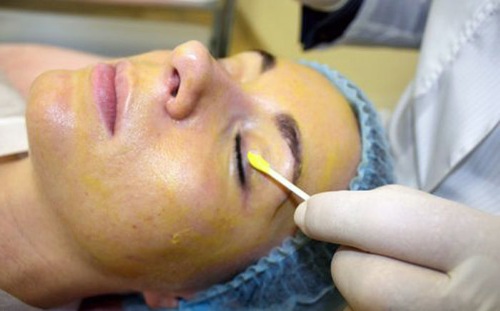 Kémiai peeling az arcra a szalonban és otthon. Vélemények, fotók előtt és után, előnyök és hátrányok