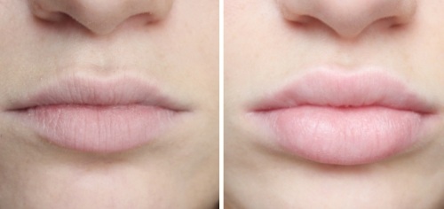 Cómo agrandar labios con ácido hialurónico, botox, silicona, lipofilling, queiloplastia. Resultados: fotos antes y después, precios, reseñas