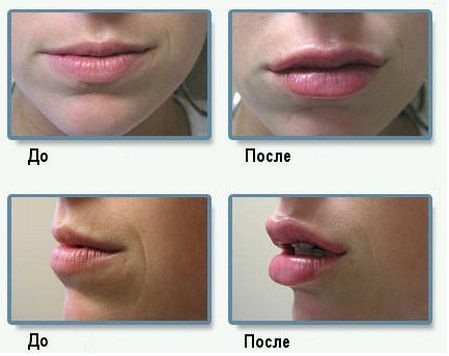 Hogyan lehet nagyítani az ajkakat hialuronsavval, botox-szal, szilikonnal, lipofillinggel, cheiloplasztikával. Eredmények: fotók előtt és után, árak, vélemények