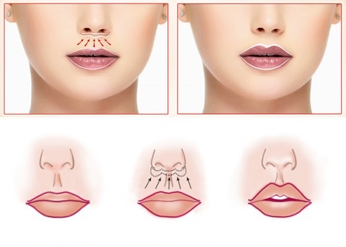 How to enlarge lips with hyaluronic acid, botox, silicone, lipofilling, cheiloplasty. Results: before and after photos, prices, reviews