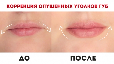Como aumentar os lábios com ácido hialurônico, botox, silicone, lipofilling, queiloplastia. Resultados: fotos antes e depois, preços, comentários