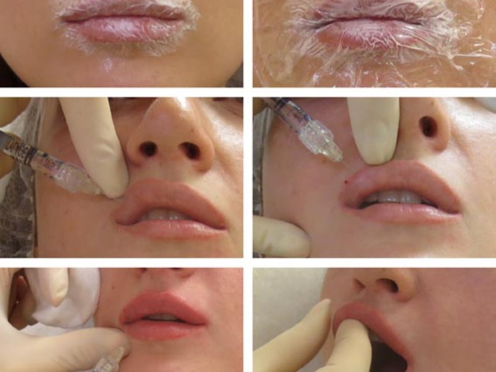 Como aumentar os lábios com ácido hialurônico, botox, silicone, lipofilling, queiloplastia. Resultados: fotos antes e depois, preços, comentários