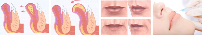 Comment agrandir les lèvres avec de l'acide hyaluronique, du botox, du silicone, du lipofilling, de la cheiloplastie. Résultats: photos avant et après, prix, avis