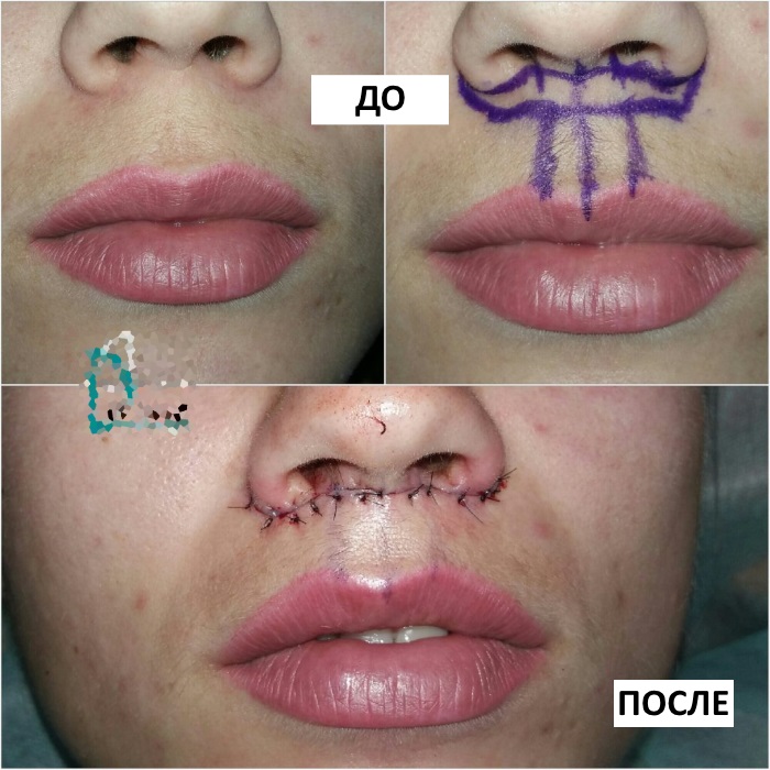 Come ingrandire le labbra con acido ialuronico, botox, silicone, lipofilling, cheiloplastica. Risultati: foto prima e dopo, prezzi, recensioni