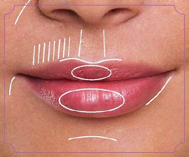 Wie man die Lippen mit Hyaluronsäure, Botox, Silikon, Lipofilling, Cheiloplastik vergrößert. Ergebnisse: vor und nach Fotos, Preisen, Bewertungen