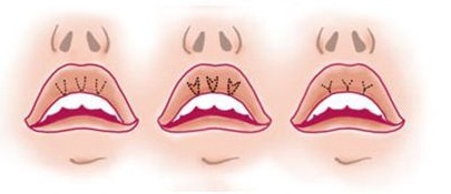 Hogyan lehet nagyítani az ajkakat hialuronsavval, botox-szal, szilikonnal, lipofillinggel, cheiloplasztikával. Eredmények: fotók előtt és után, árak, vélemények