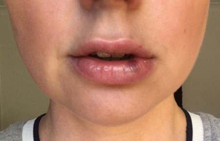 Cara membesarkan bibir dengan asid hyaluronik, botox, silikon, lipofilling, cheiloplasty. Hasil: sebelum dan selepas foto, harga, ulasan