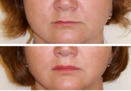Cara membesarkan bibir dengan asid hyaluronik, botox, silikon, lipofilling, cheiloplasty.Hasil: sebelum dan selepas foto, harga, ulasan