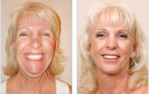 Lifting facial circular. Fotos antes y después, el precio, cómo se realiza la operación quirúrgicamente, con hilos y sin cirugía. Reseñas y precios