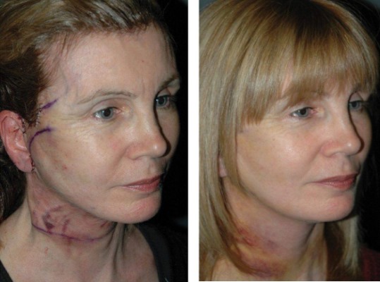 Lifting facial circular. Fotos abans i després, el preu, com es realitza l’operació quirúrgicament, amb fils i sense cirurgia. Ressenyes i preus