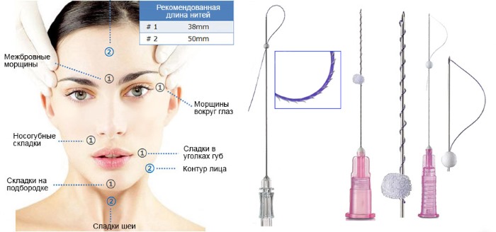 Lifting facial circular. Fotos antes y después, el precio, cómo se realiza la operación quirúrgicamente, con hilos y sin cirugía. Reseñas y precios