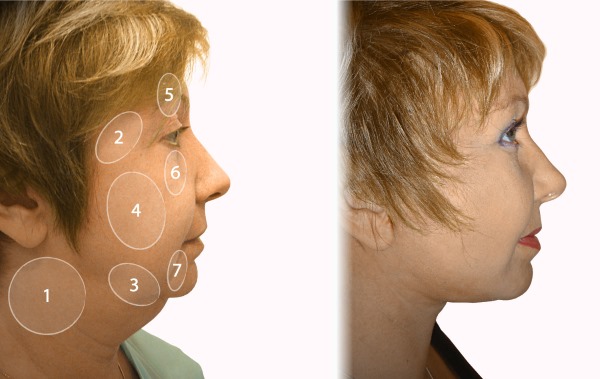 Lifting facial circular. Fotos abans i després, el preu, com es realitza l’operació quirúrgicament, amb fils i sense cirurgia. Ressenyes i preus