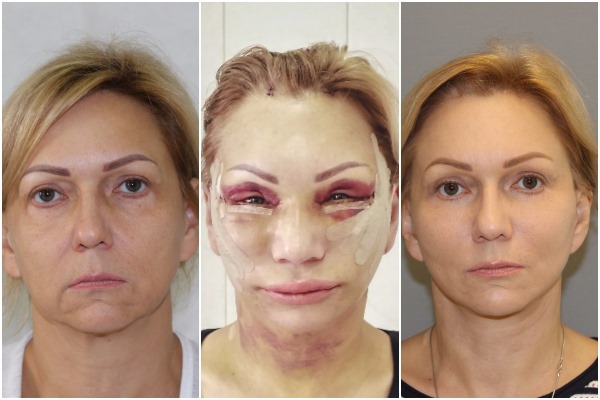 Lifting facial circular.Fotos abans i després, el preu, com es realitza l’operació quirúrgicament, amb fils i sense cirurgia. Ressenyes i preus