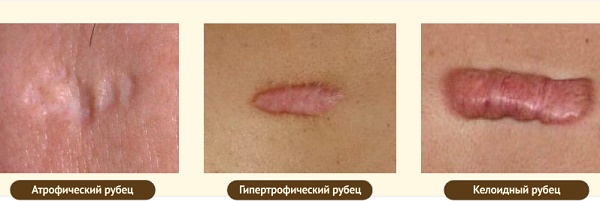 Pomadas para cicatrizes e cicatrizes no rosto após acne, varicela, blefaroplastia, cirurgia. Meios eficazes e baratos